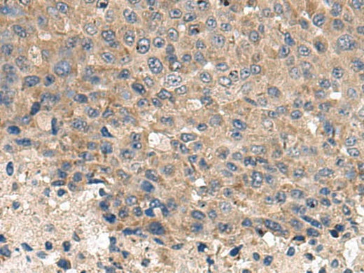 Immunohistochemistry of paraffin-embedded Human liver cancer tissue using CD59 Polyclonal Antibody at dilution of 1:120(×200)