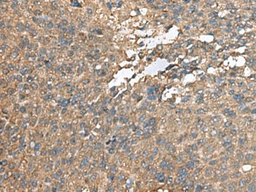 Immunohistochemistry of paraffin-embedded Human liver cancer tissue using AHNAK Polyclonal Antibody at dilution of 1:100(×200)