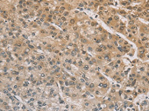 Immunohistochemistry of paraffin-embedded Human liver cancer tissue using ZIC2 Polyclonal Antibody at dilution of 1:100(×200)