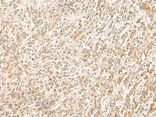 Immunohistochemistry of paraffin-embedded Human gastric cancer tissue using MYCT1 Polyclonal Antibody at dilution of 1:35(×200)