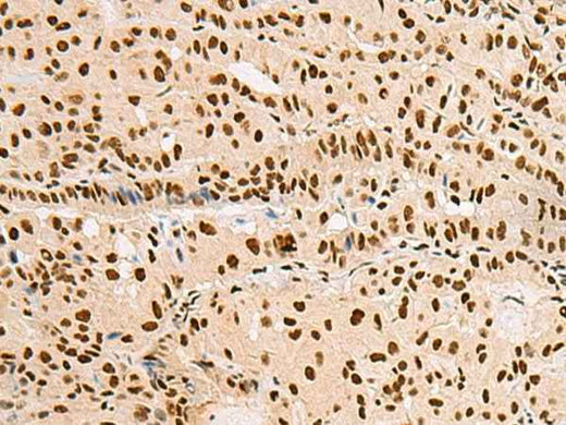 Immunohistochemistry of paraffin-embedded Human thyroid cancer tissue using XRCC4 Polyclonal Antibody at dilution of 1:60(×200)