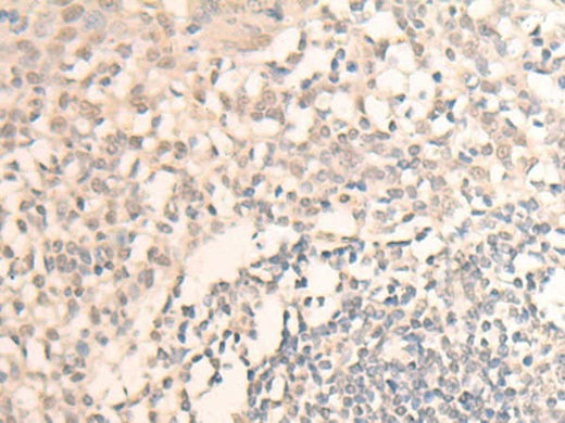 Immunohistochemistry of paraffin-embedded Human tonsil tissue using MLLT6 Polyclonal Antibody at dilution of 1:40(×200)