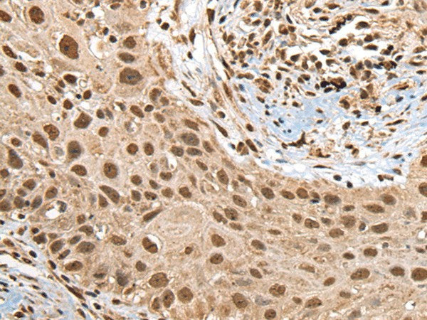 Immunohistochemistry of paraffin-embedded Human lung cancer tissue using RTCB Polyclonal Antibody at dilution of 1:45(×200)