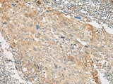 Immunohistochemistry of paraffin-embedded Human cervical cancer tissue using GPR151 Polyclonal Antibody at dilution of 1:45(×200)