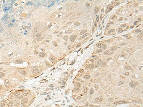 Immunohistochemistry of paraffin-embedded Human esophagus cancer tissue using OTX1 Polyclonal Antibody at dilution of 1:30(×200)