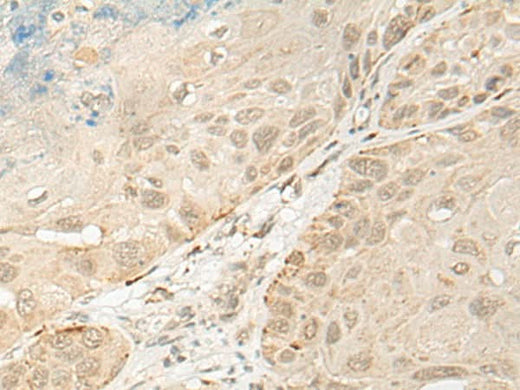 Immunohistochemistry of paraffin-embedded Human esophagus cancer tissue using OTX1 Polyclonal Antibody at dilution of 1:30(×200)
