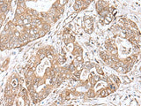Immunohistochemistry of paraffin-embedded Human gastric cancer tissue using TEAD2 Polyclonal Antibody at dilution of 1:60(×200)