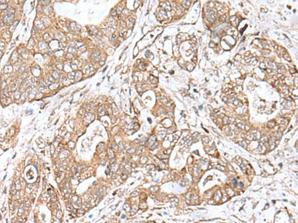 Immunohistochemistry of paraffin-embedded Human gastric cancer tissue using TEAD2 Polyclonal Antibody at dilution of 1:60(×200)
