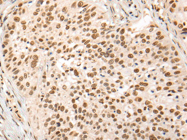 Immunohistochemistry of paraffin-embedded Human lung cancer tissue using HOXA7 Polyclonal Antibody at dilution of 1:70(×200)