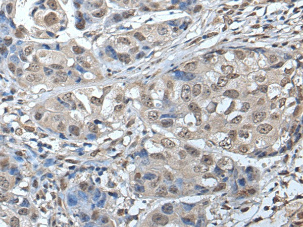 Immunohistochemistry of paraffin-embedded Human breast cancer tissue using SMC1A Polyclonal Antibody at dilution of 1:45(×200)