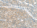 Immunohistochemistry of paraffin-embedded Human liver cancer tissue using UBE2G2 Polyclonal Antibody at dilution of 1:55(×200)