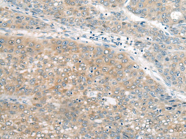 Immunohistochemistry of paraffin-embedded Human liver cancer tissue using UBE2G2 Polyclonal Antibody at dilution of 1:55(×200)