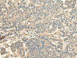 Immunohistochemistry of paraffin-embedded Human liver cancer tissue using CCDC113 Polyclonal Antibody at dilution of 1:65(×200)