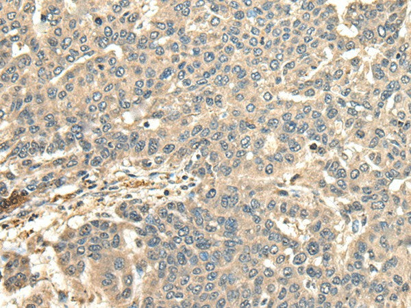 Immunohistochemistry of paraffin-embedded Human liver cancer tissue using CCDC113 Polyclonal Antibody at dilution of 1:65(×200)
