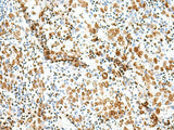 Immunohistochemistry of paraffin-embedded Human cervical cancer tissue using TCOF1 Polyclonal Antibody at dilution of 1:50(×200)
