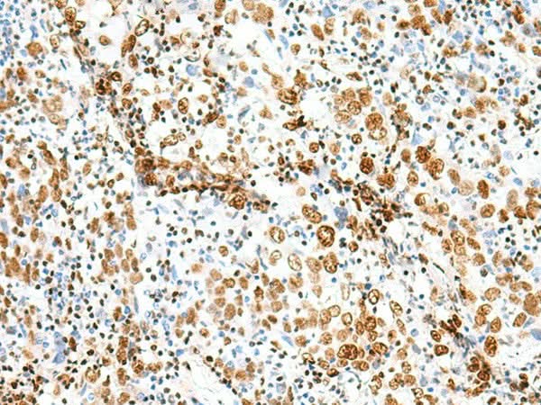 Immunohistochemistry of paraffin-embedded Human cervical cancer tissue using TCOF1 Polyclonal Antibody at dilution of 1:50(×200)