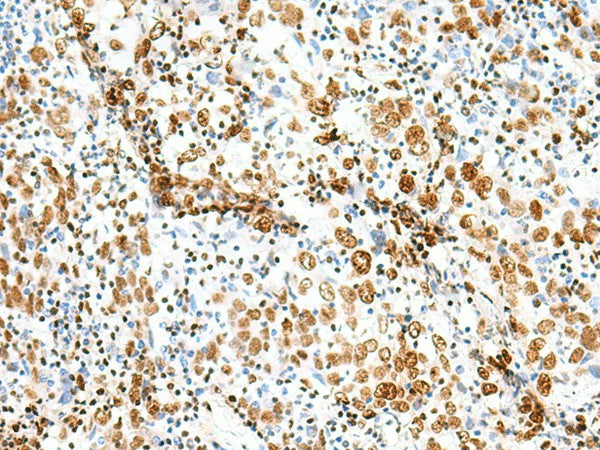 Immunohistochemistry of paraffin-embedded Human cervical cancer tissue using TCOF1 Polyclonal Antibody at dilution of 1:50(×200)