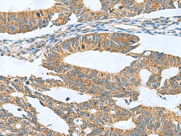 Immunohistochemistry of paraffin-embedded Human colorectal cancer tissue using CLEC1B Polyclonal Antibody at dilution of 1:60(×200)