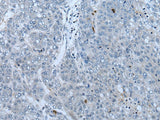 Immunohistochemistry of paraffin-embedded Human liver cancer tissue using NF1 Polyclonal Antibody at dilution of 1:65(×200)
