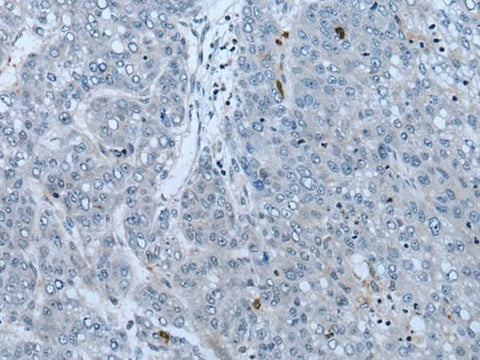 Immunohistochemistry of paraffin-embedded Human liver cancer tissue using NF1 Polyclonal Antibody at dilution of 1:65(×200)