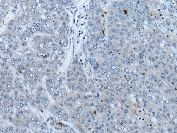 Immunohistochemistry of paraffin-embedded Human liver cancer tissue using NF1 Polyclonal Antibody at dilution of 1:65(×200)