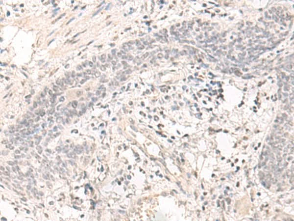 Immunohistochemistry of paraffin-embedded Human esophagus cancer tissue using SAP130 Polyclonal Antibody at dilution of 1:35(×200)