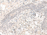 Immunohistochemistry of paraffin-embedded Human esophagus cancer tissue using SAP130 Polyclonal Antibody at dilution of 1:35(×200)