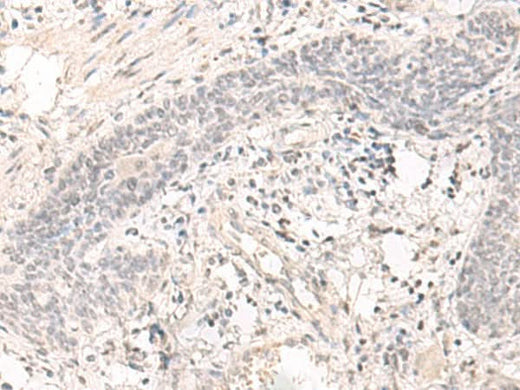 Immunohistochemistry of paraffin-embedded Human esophagus cancer tissue using SAP130 Polyclonal Antibody at dilution of 1:35(×200)