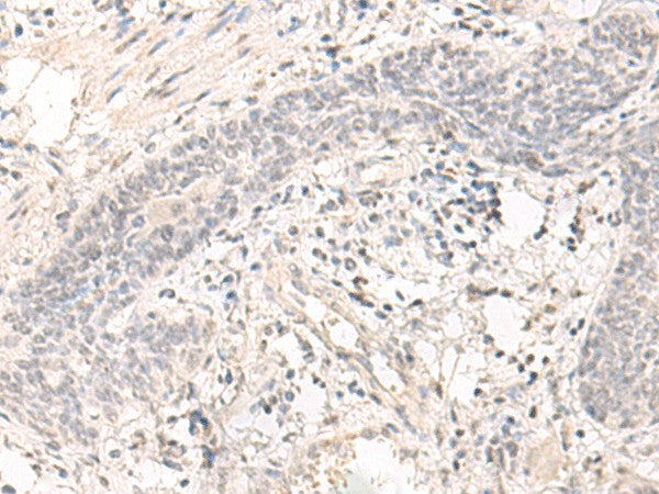 Immunohistochemistry of paraffin-embedded Human esophagus cancer tissue using SAP130 Polyclonal Antibody at dilution of 1:35(×200)