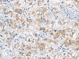 Immunohistochemistry of paraffin-embedded Human liver cancer tissue using GCSH Polyclonal Antibody at dilution of 1:60(×200)