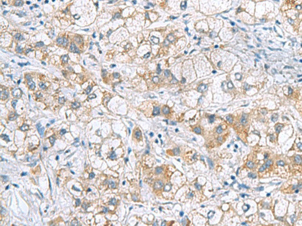 Immunohistochemistry of paraffin-embedded Human liver cancer tissue using GCSH Polyclonal Antibody at dilution of 1:60(×200)