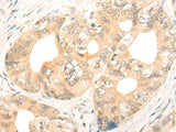 Immunohistochemistry of paraffin-embedded Human gastric cancer tissue using CD86 Polyclonal Antibody at dilution of 1:55(×200)