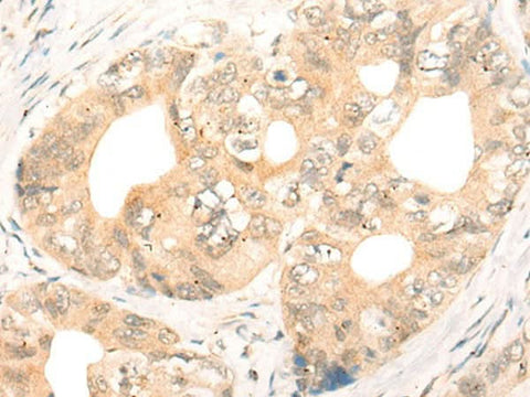 Immunohistochemistry of paraffin-embedded Human gastric cancer tissue using CD86 Polyclonal Antibody at dilution of 1:55(×200)