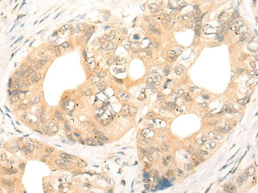Immunohistochemistry of paraffin-embedded Human gastric cancer tissue using CD86 Polyclonal Antibody at dilution of 1:55(×200)