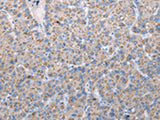 Immunohistochemistry of paraffin-embedded Human liver cancer tissue using FKBPL Polyclonal Antibody at dilution of 1:50(×200)