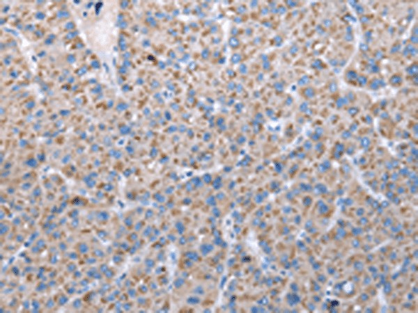 Immunohistochemistry of paraffin-embedded Human liver cancer tissue using FKBPL Polyclonal Antibody at dilution of 1:50(×200)
