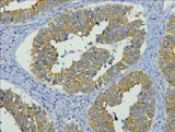 Immunohistochemistry of paraffin-embedded Human colon cancer tissue using CK-19 Monoclonal Antibody at dilution of 1:200.
