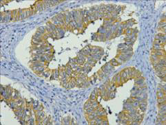 Immunohistochemistry of paraffin-embedded Human colon cancer tissue using CK-19 Monoclonal Antibody at dilution of 1:200.