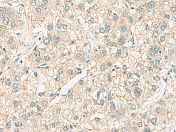 Immunohistochemistry of paraffin-embedded Human liver cancer tissue using C3orf38 Polyclonal Antibody at dilution of 1:95(×200)