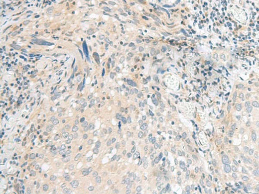 Immunohistochemistry of paraffin-embedded Human cervical cancer tissue using CALCOCO1 Polyclonal Antibody at dilution of 1:40(×200)