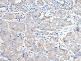 Immunohistochemistry of paraffin-embedded Human breast cancer tissue using RASA1 Polyclonal Antibody at dilution of 1:45(×200)