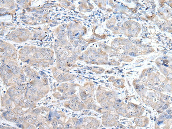 Immunohistochemistry of paraffin-embedded Human breast cancer tissue using RASA1 Polyclonal Antibody at dilution of 1:45(×200)