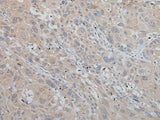 Immunohistochemistry of paraffin-embedded Human esophagus cancer tissue using MLANA Polyclonal Antibody at dilution of 1:50(×200)