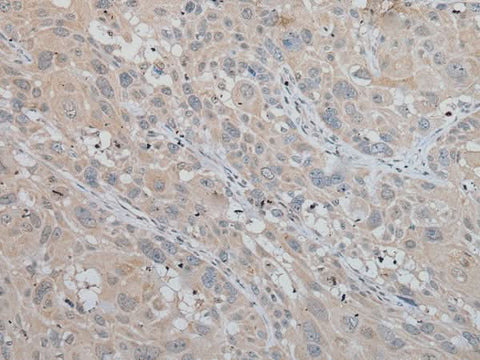 Immunohistochemistry of paraffin-embedded Human esophagus cancer tissue using MLANA Polyclonal Antibody at dilution of 1:50(×200)