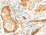 Immunohistochemistry of paraffin-embedded Human esophagus cancer tissue using SETMAR Polyclonal Antibody at dilution of 1:60(×200)