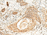 Immunohistochemistry of paraffin-embedded Human esophagus cancer tissue using KCTD13 Polyclonal Antibody at dilution of 1:55(×200)