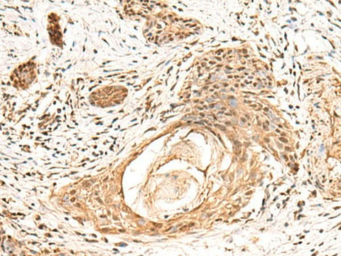 Immunohistochemistry of paraffin-embedded Human esophagus cancer tissue using KCTD13 Polyclonal Antibody at dilution of 1:55(×200)
