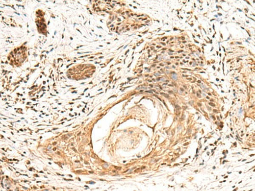 Immunohistochemistry of paraffin-embedded Human esophagus cancer tissue using KCTD13 Polyclonal Antibody at dilution of 1:55(×200)