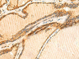 Immunohistochemistry of paraffin-embedded Human thyroid cancer tissue using LYZL1 Polyclonal Antibody at dilution of 1:50(×200)