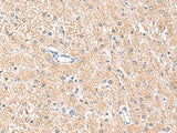 Immunohistochemistry of paraffin-embedded Human liver cancer tissue using MLKL Polyclonal Antibody at dilution of 1:85(×200)